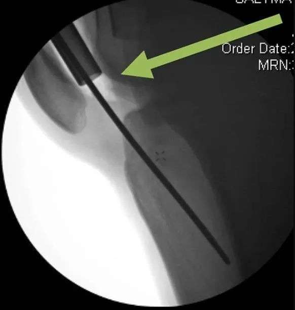 ការបាក់ឆ្អឹង Tibial, Suprapatellar Litrimalullary Litique-22