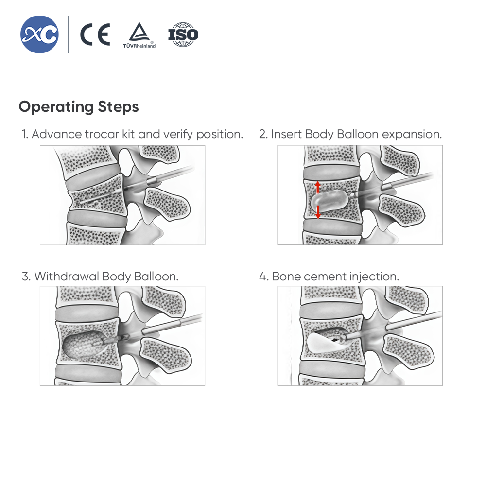 Kyphoplasty System (PKP) | Vertebral Balloon & Cement Kit