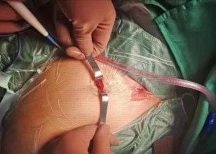 Dijanjosi u Trattament ta 'Frattura ta' Clavicle-23