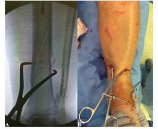 បច្ចេកទេសជួសជុលក្រចក Tibial Tibial Tripationullalary -7