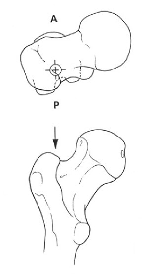 5 intramedullary nail application principles and surgical techniques-11