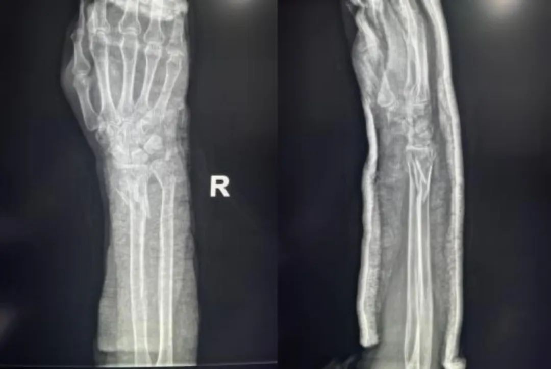 Distal Radius Fractures-15