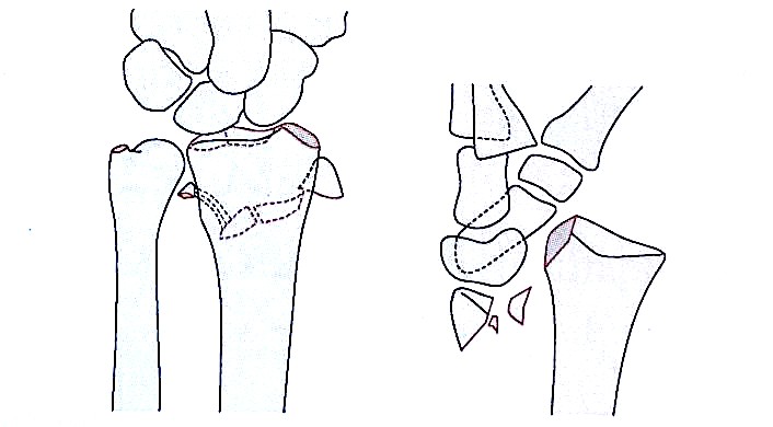 Distal Radius Fractures-6