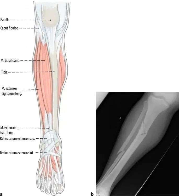 ការបាក់ឆ្អឹង Tibial, Suprapatellar Litrimallary Tearique-2