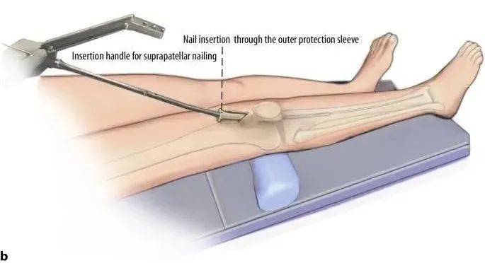 ការបាក់ឆ្អឹង Tibial, Suprapatellar Litrimullalary Tearique-17