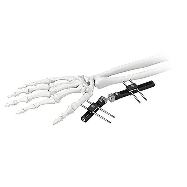 Wrist-External-Fixator