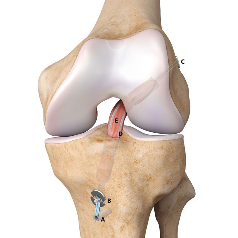 Ligament reconstruction