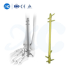Hindfoot Fusion Ankle Nail - Buy Product on XC Medico