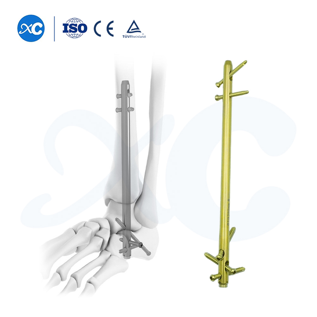 Hindfoot Fusion Ankle Nail - Buy Product on XC Medico