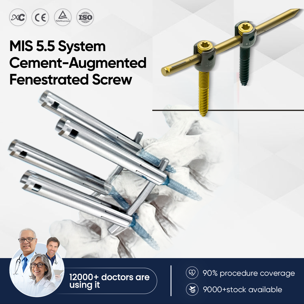 MIS 5.5 cement-augmented fenestrated screw