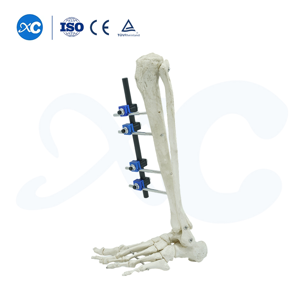  External Fixator for Leg - Buy Product on XC Medico