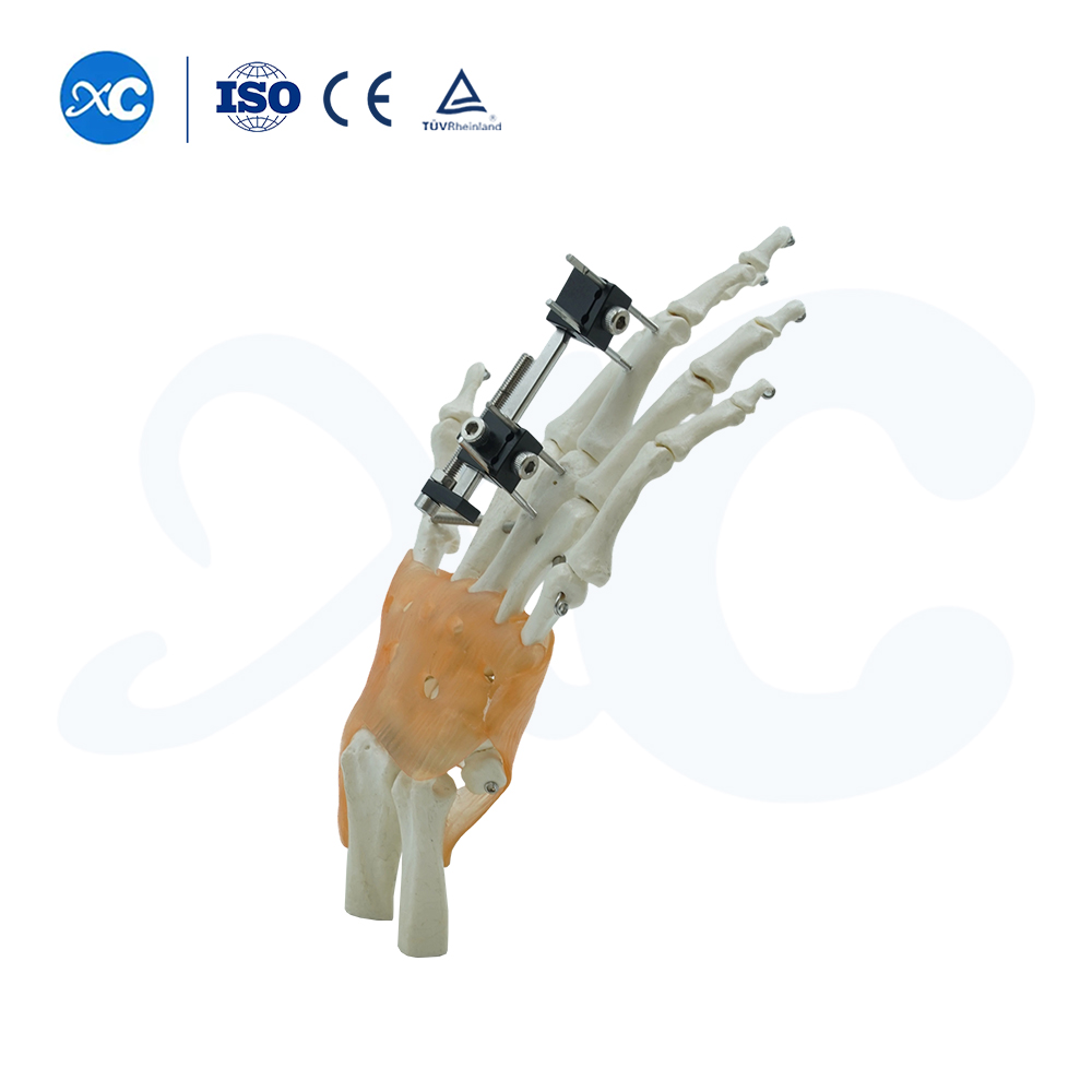 Mini Fixator Universal Compression Extension Type