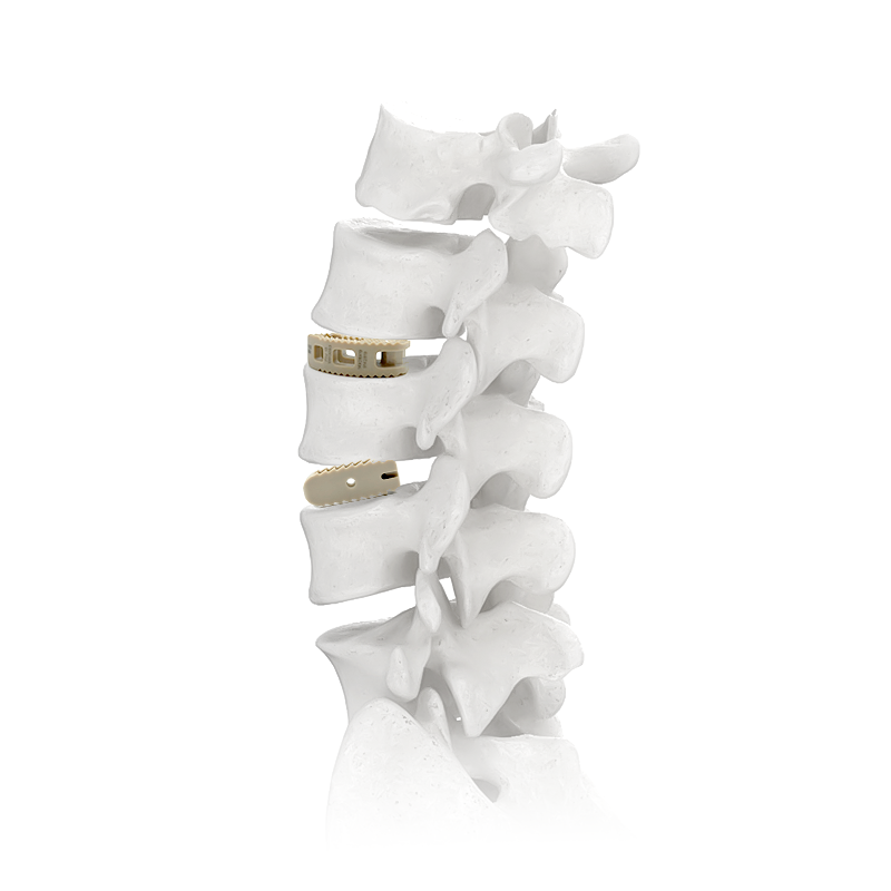 What Makes PEEK Cages Ideal for Spinal Implants