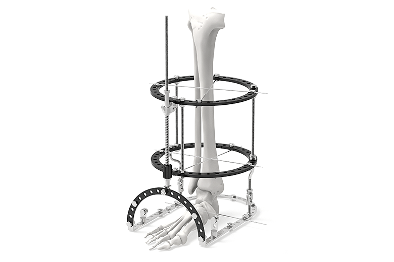 Ilizarov Circular External Fixators