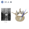 Kyphoplasty System (PKP) | Vertebral Balloon & Cement Kit