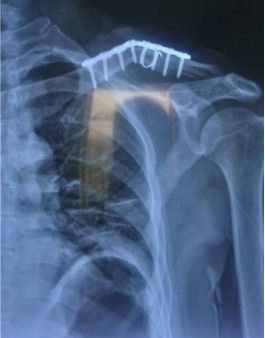 Dijanjosi u Trattament ta 'Frattura ta' Clavicle-31