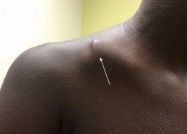 Dijanjosi u Trattament ta 'Frattura ta' Clavicle-15