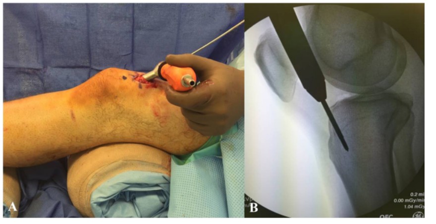 បច្ចេកទេសជួសជុលក្រចក Tibial Tibial intripallary-3