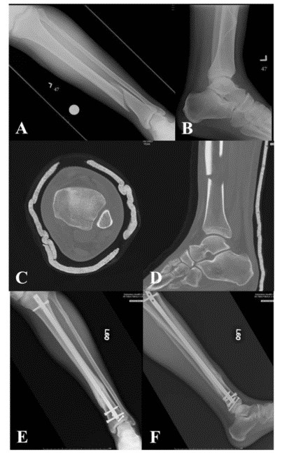 បច្ចេកទេសជួសជុលក្រចក Tibial tibiquullumellary-2