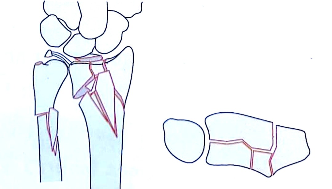 Distal Radius Fractures-7