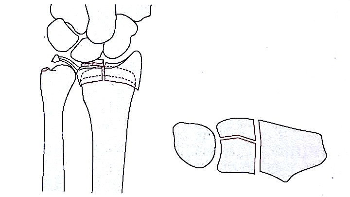 Distal Radius Fractures-5