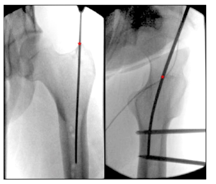 Femoral Intramedullary Nailing - How To Choose The Best Insertion Point-3