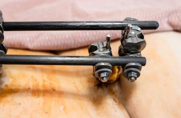 External fixation banner-7