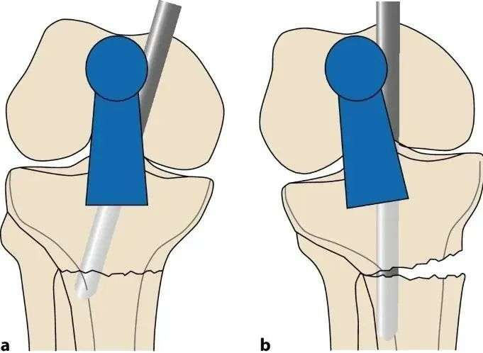 ការបាក់ឆ្អឹង Tibial, TrinationAllar Intristullally Trail-on-1