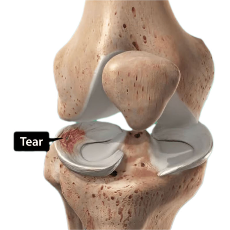Meniscus repair