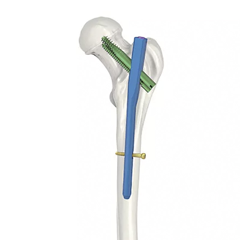 intramedullary nail system 
