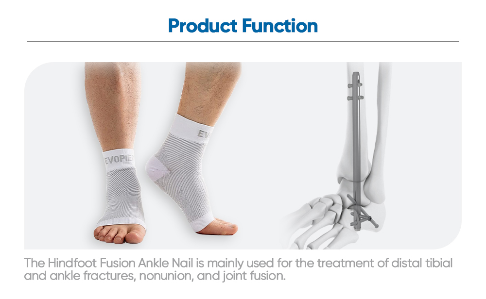 Hindfoot Fusion Ankle Nail - Buy Product on XC Medico
