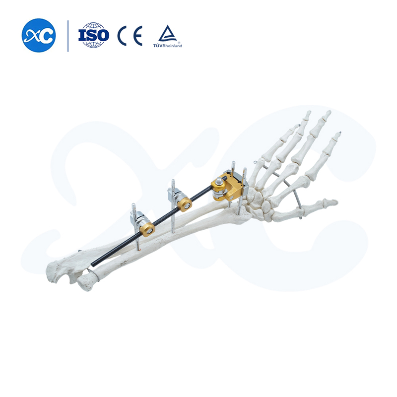 Upper Limb External Fixators - Buy Product on XC Medico