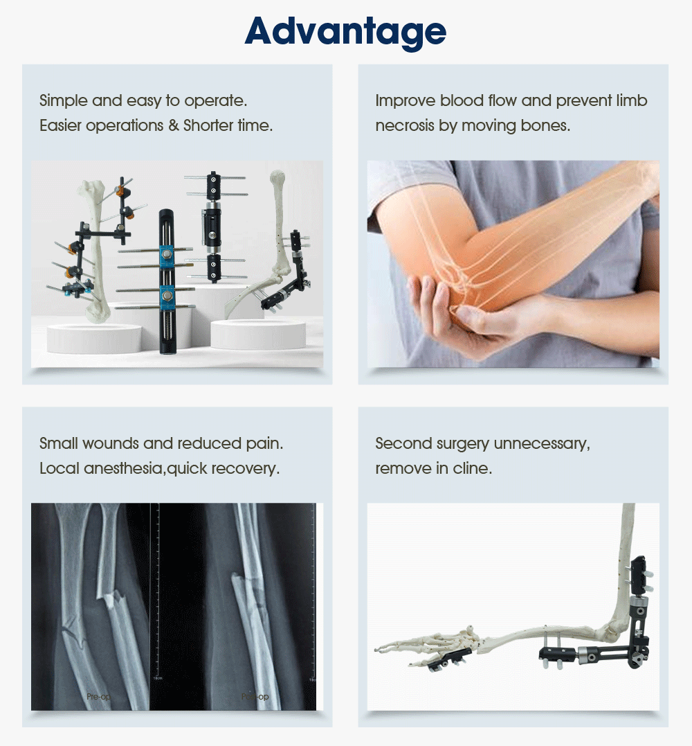 Upper Limb External Fixators - Buy Product on XC Medico