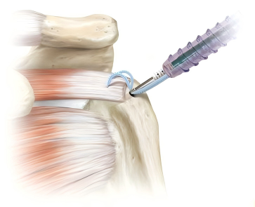 Can suture tape help your rotator cuff heal better