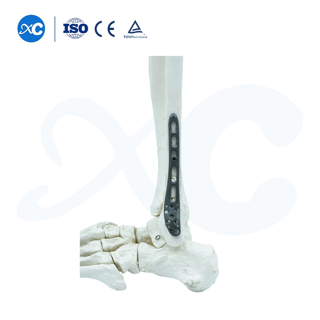 Distal Tibiofibular Locking Plate-I - Buy Product on XC Medico
