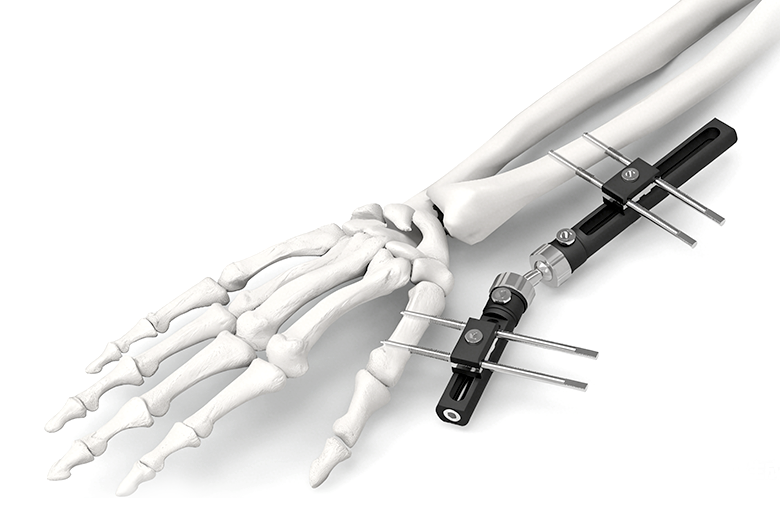 Monolateral External Fixation Systems