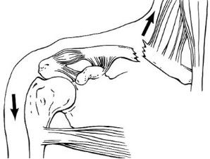 Dijanjosi u Trattament ta 'Frattura ta' Clavicle-2
