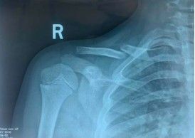 Dijanjosi u Trattament ta 'Frattura ta' Clavicle-8