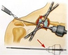 Dijanjosi u Trattament ta 'Frattura ta' Clavicle-18