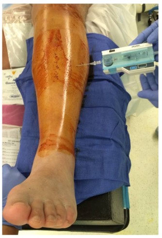 បច្ចេកទេសជួសជុលក្រចក Tibial