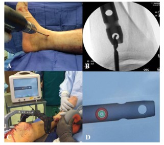 បច្ចេកទេសជួសជុលក្រចក Tibial Tibial Tipitionullary-11