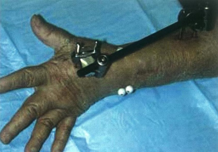 Distal Radius Fractures-10