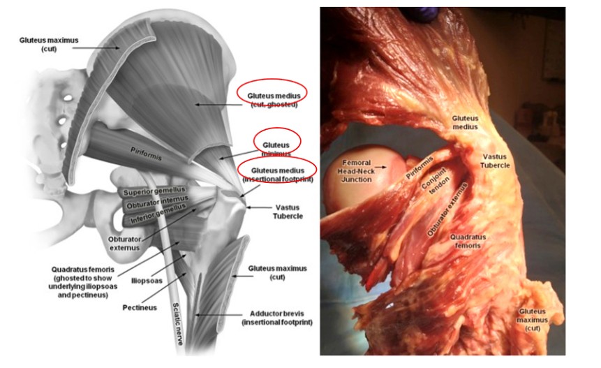 Femoral Intramedullary Nailing - How To Choose The Best Insertion Point-1