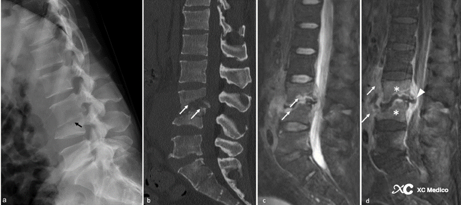 Summary Of The Characteristics Of Various Spinal Infections