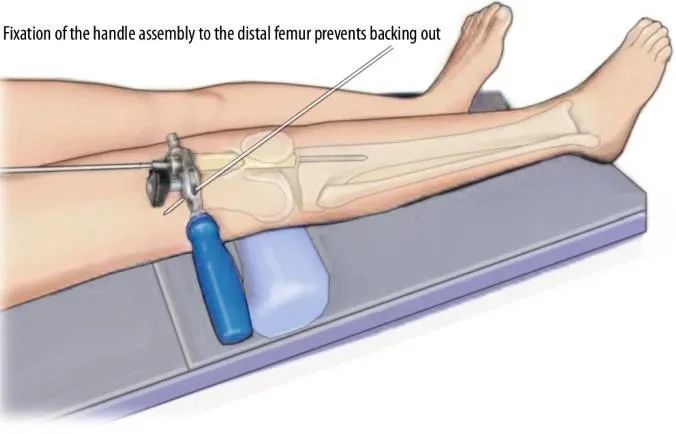 ការបាក់ឆ្អឹង Tibial, Suprapatellar intripstrationullary Lail Techique-12