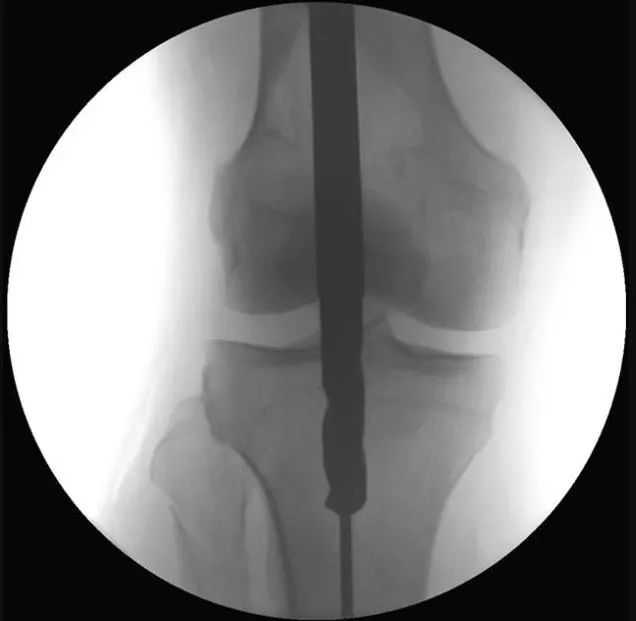 ការបាក់ឆ្អឹង Tibial, Suprapatellar Litrimallurary Tear-Liquitique-13