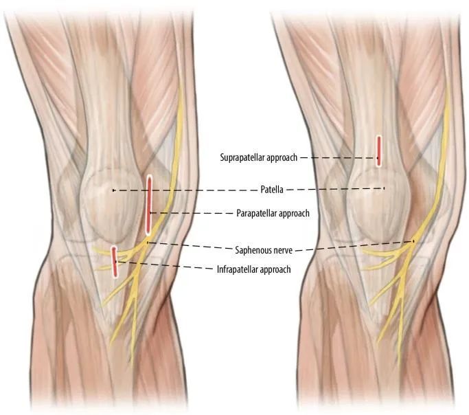 ការបាក់ឆ្អឹង Tibial, Suprapatellar Litrimullary Tearique-3