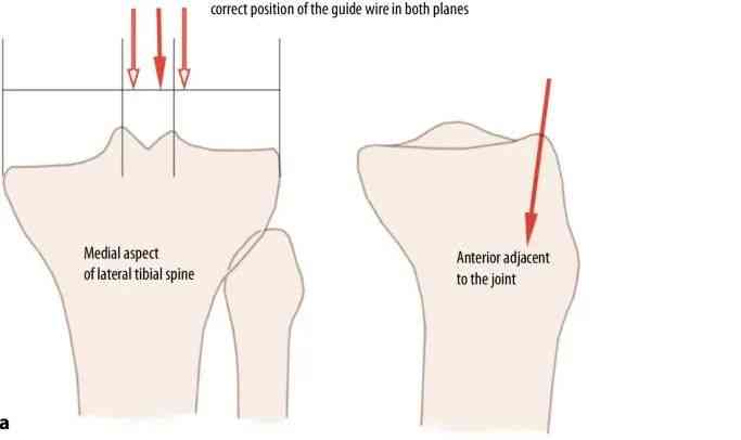 ការបាក់ឆ្អឹង Tibial, Suprapatellar intriathullary បច្ចេកទេសក្រចក -10