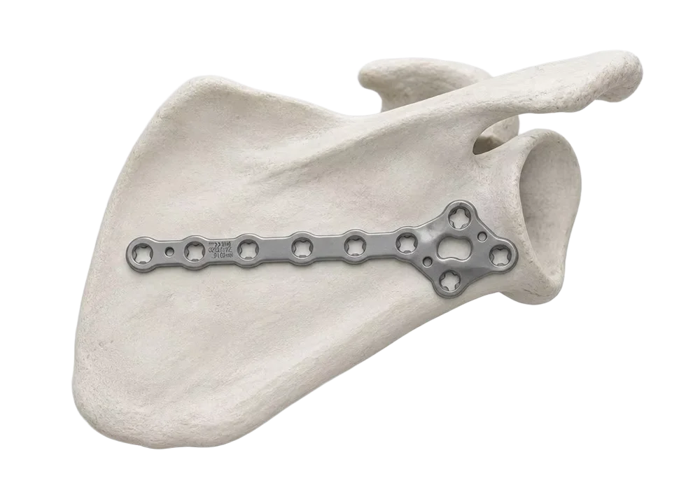 Lateral scapula fracture fixation