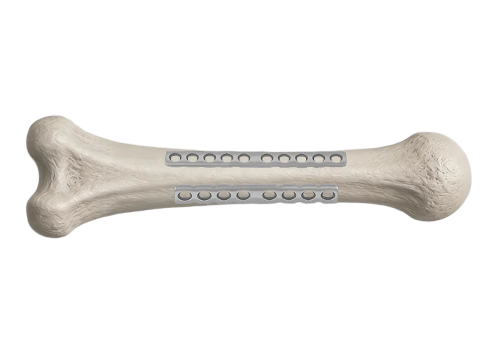 Compression plate pathways for humeral shaft fixation